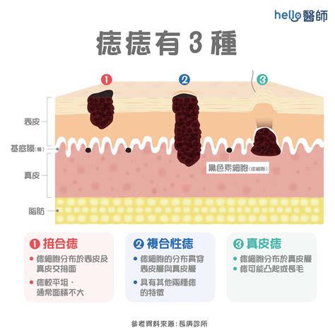 陰莖長痣